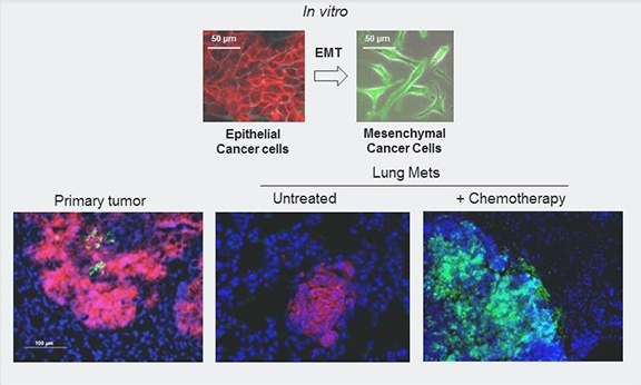 The top panel of this image shows breast cancer cells designed to change from red to green when they transition from epithelial to mesenchymal. breast cancer cells
