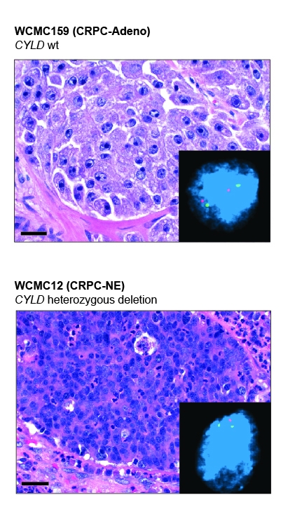 Microscopic images of treatment-resistant prostate cancer. The top panel shows typical prostate cancer, known as adenocarcinoma, while the bottom depicts neuroendocrine prostate cancer. images of treatment-resistant prostate cancer