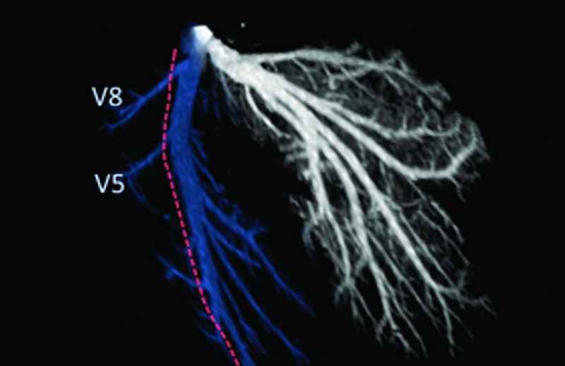 Kinder cut: An image of the left and right hepatic veins, and (in red) the line of transection for liver transplant. hepatic veins