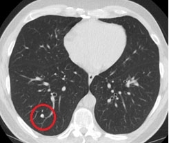 lung cancer cat scan