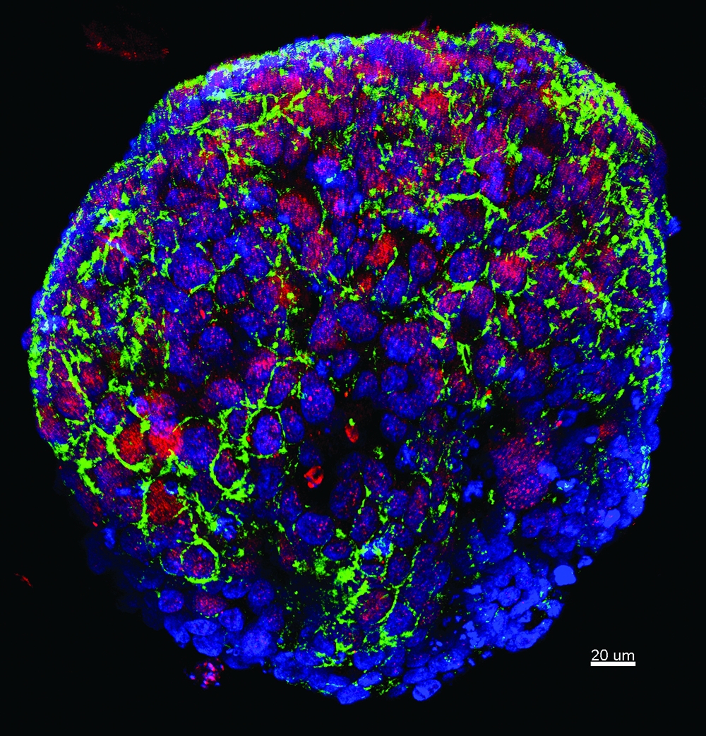 Tumor cells