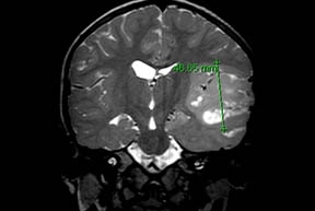 MRI showing a glial tumor infiltrating the temporal lobe of the brain. MRI showing a glial tumor infiltrating the temporal lobe of the brain