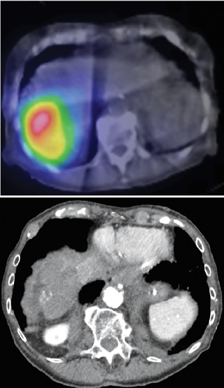 Imaging after Bloome’s procedure (top) shows radioactivity at the site of her tumor; (left) four years after the treatment, only a small area of calcification remained. Opposite page: Bloome (right) at home during her twice-weekly physical therapy session