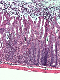 A microscopic image of a severely inflamed mouse colon lacking molecule MHCII