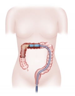 Endolumenal Surgical Platform